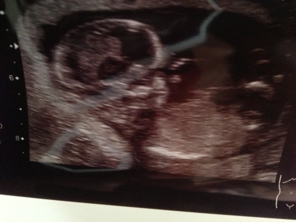 Dating scan and consultant appointment